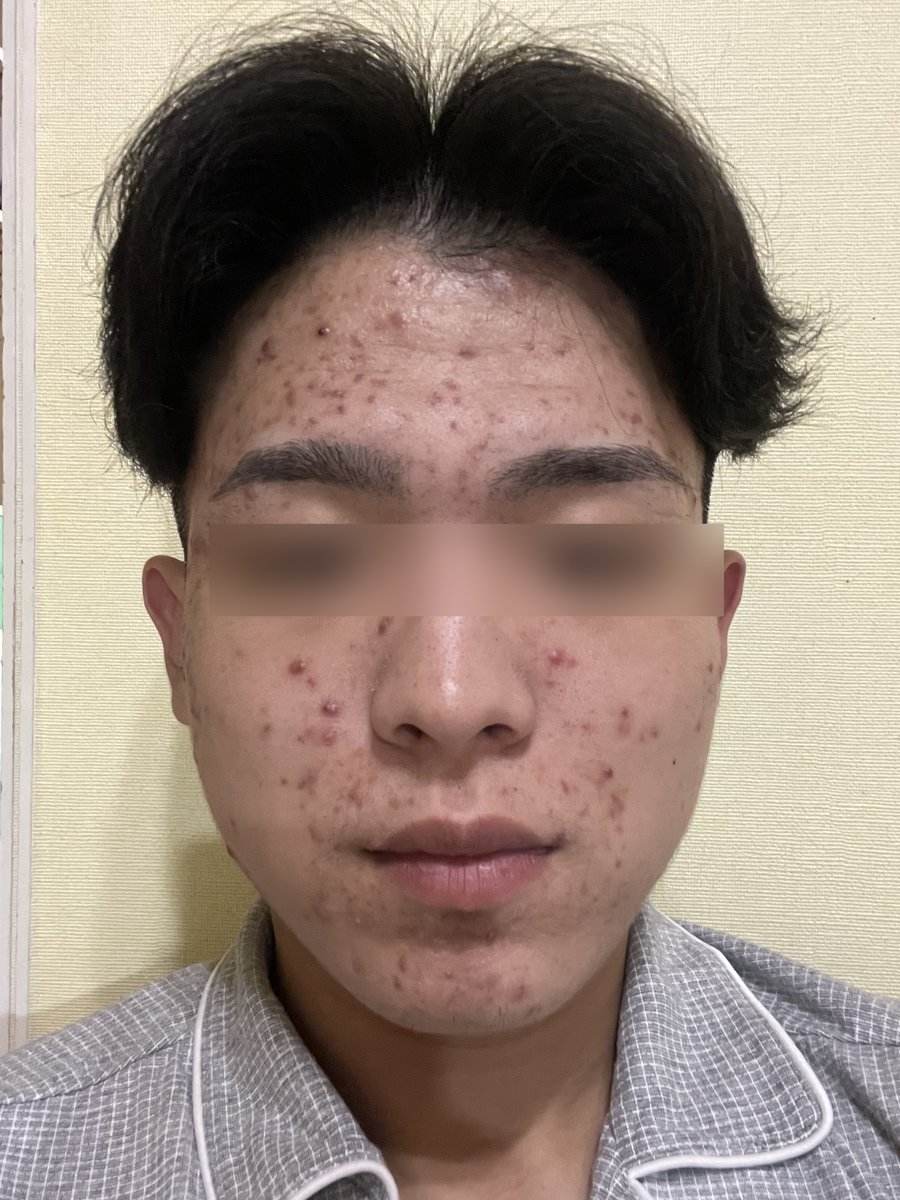 ニキビに悩んでいた頃の肌の写真（目元は加工済み）