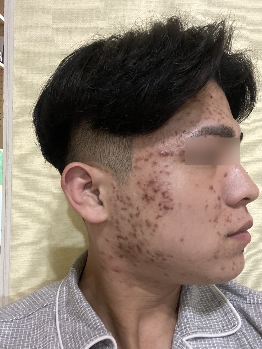 ニキビに悩んでいた頃の横顔の写真（目元は加工済み）